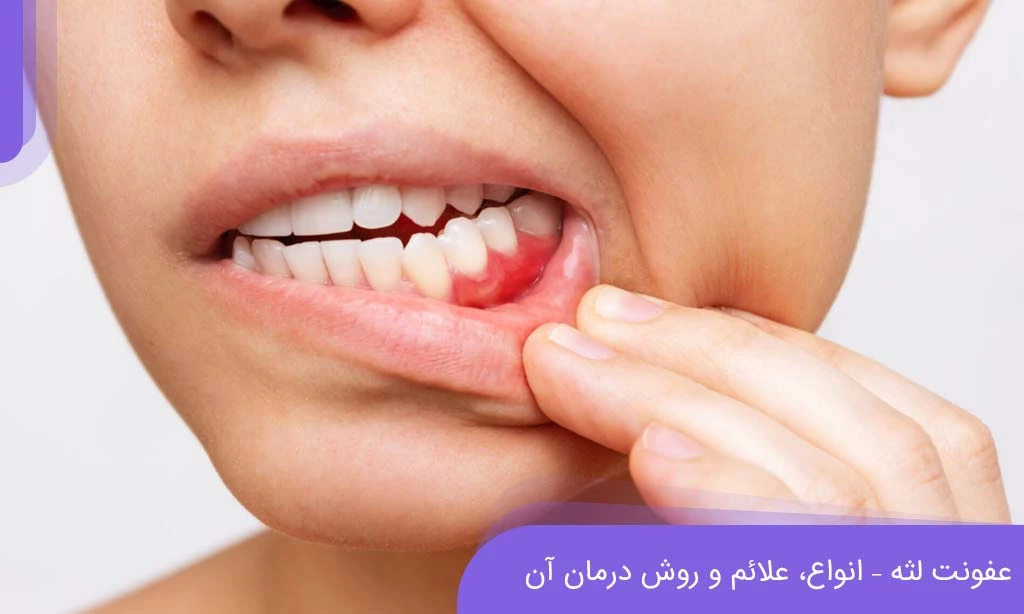 عفونت لثه یکی از مشکلات رایج دهان و دندان است.