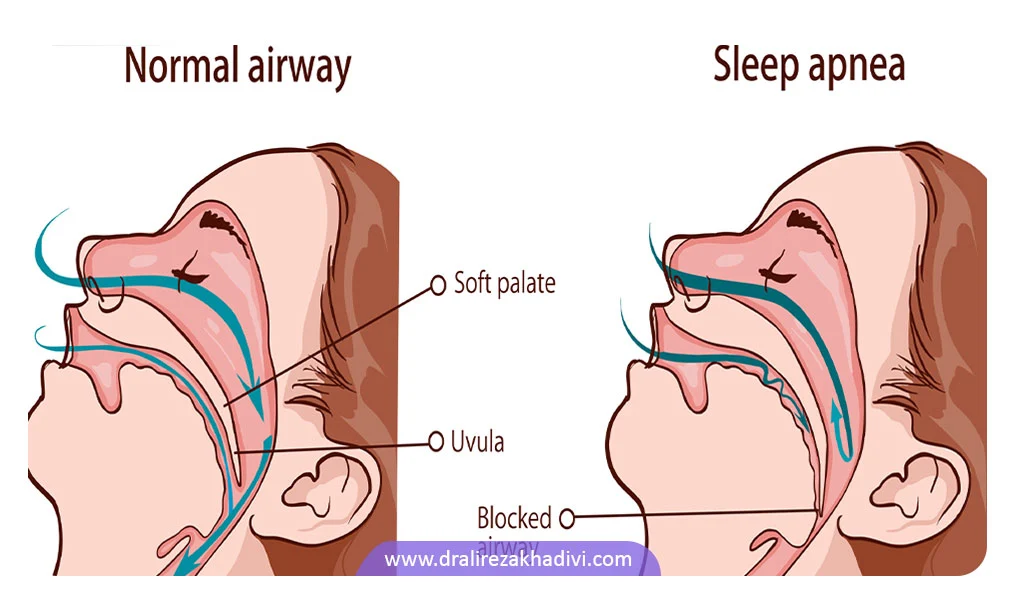 آپنه خواب چیست؟