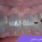 علت سیاه شدن دندان و روش های درمان