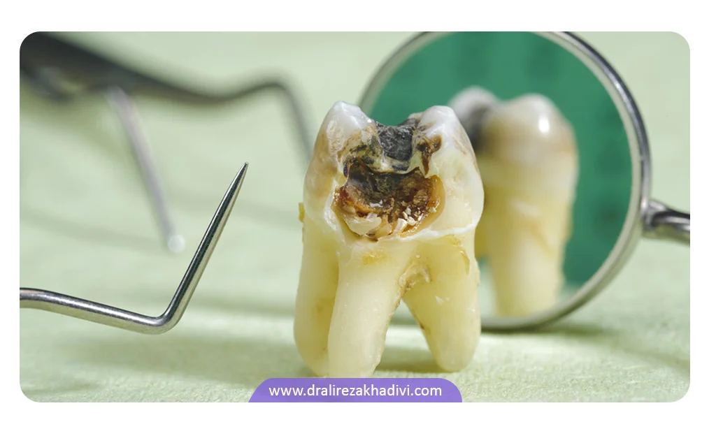سیاه شدن دندان ممکن است به دلیل عوامل خارجی باشد
