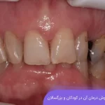 دیپ بایت دندان و روش درمان آن
