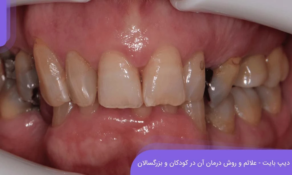دیپ بایت دندان و روش درمان آن