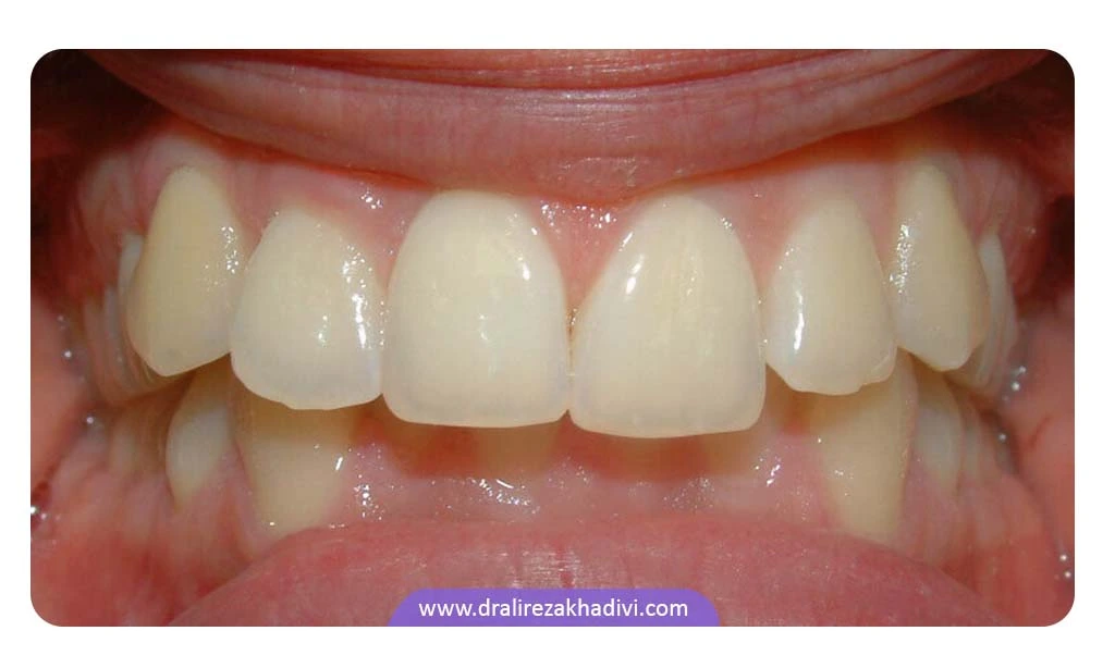 دیپ بایت دندان چیست و چه مشکلاتی ایجاد می کند؟