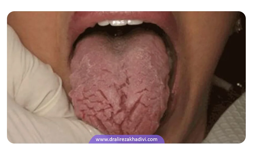 علائم خشکی دهان که ممکن است خطرناک باشد
