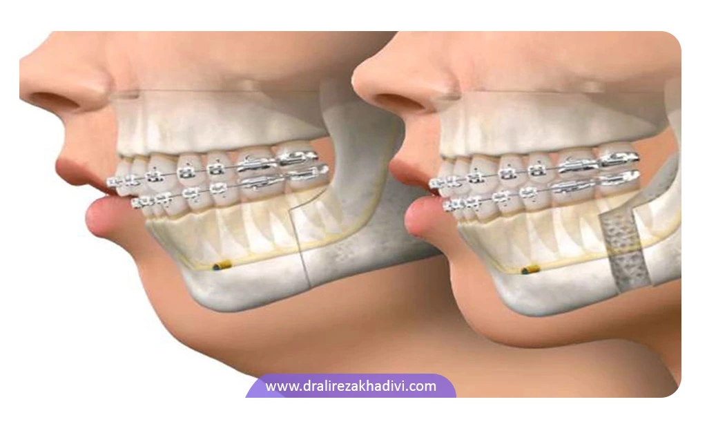 درمان کوچک بودن فک پایین با ارتودنسی
