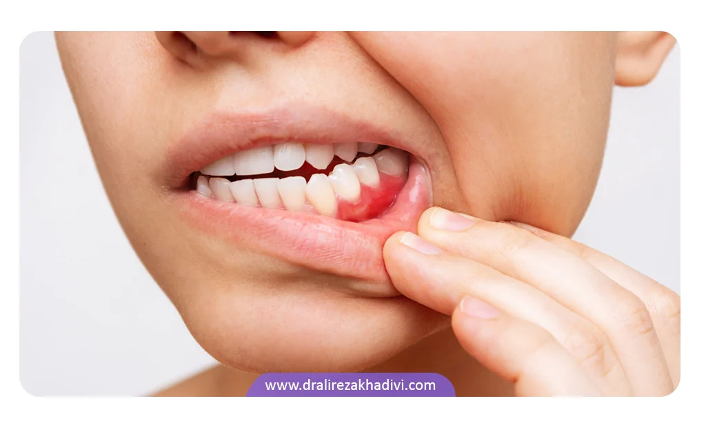 عفونت دندان می تواند موجب صدا دادن فک شود