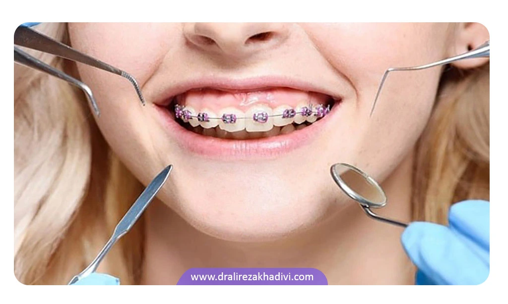 ارتودنسی دندان فک بالا به چه افرادی توصیه می‌شود؟