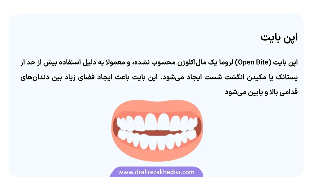 درمان اپن بایت با سیم کشی دندان