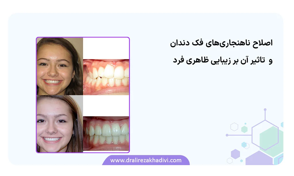 تاثیر ناهمترازی فک بر ظاهر