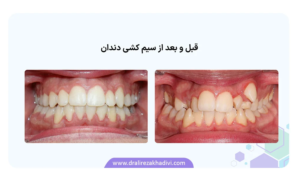 عکس قبل و بعد سیم کشی دندان