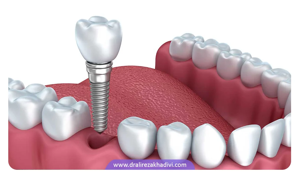 ایمپلنت دندان