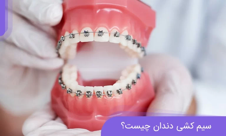 سیم کشی دندان چیست