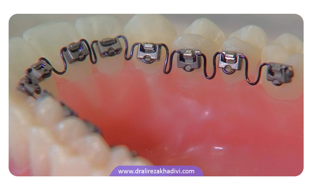 ارتودنسی جدید دندان با InBrace