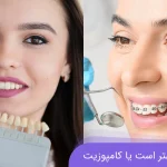 ارتودنسی بهتر است یا کامپوزیت