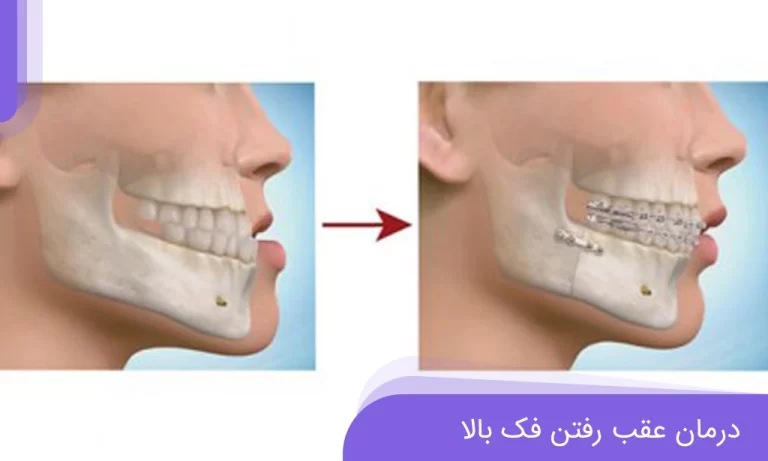 عقب بودن فک بالا چیست