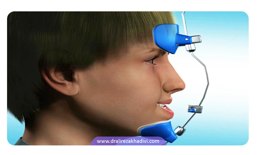 درمان عقب بودن فک بالا بدون جراحی و با کمک فیس ماسک