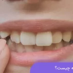 دندان اضافه چیست؟