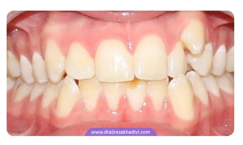 درمان دندان اضافه