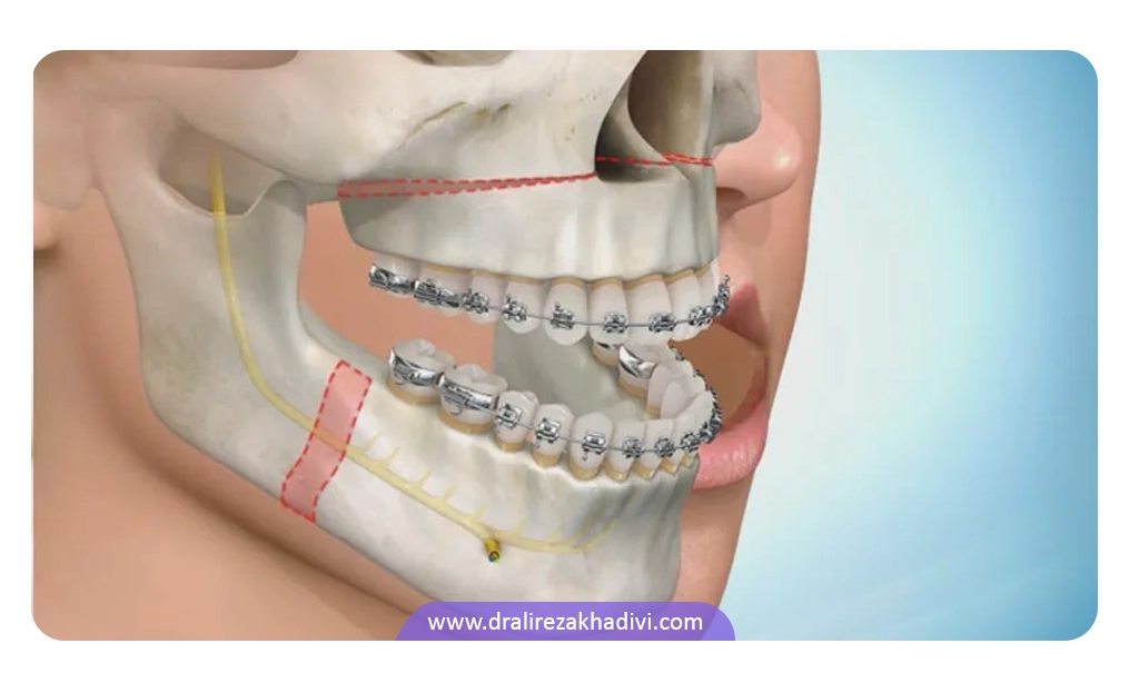 جراحی فک برای ارتودنسی
