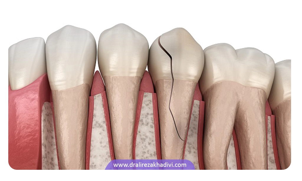 ترک خوردگی دندان