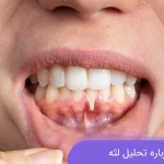 همه چیز درباره تحلیل لثه