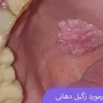 همه چیز درمورد زگیل دهانی