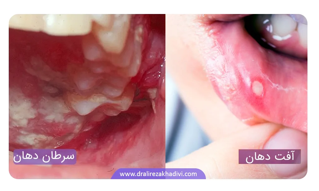 تفاوت آفت و سرطان دهان از نظر علائم ظاهری