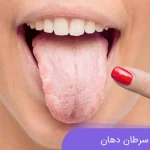 فرق آفت و سرطان دهان