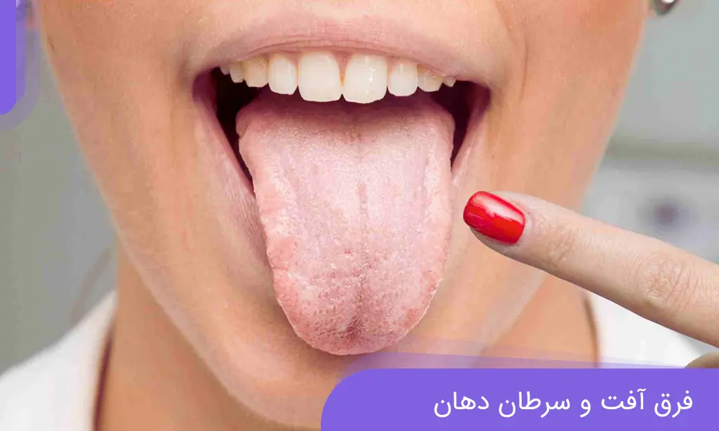 فرق آفت و سرطان دهان