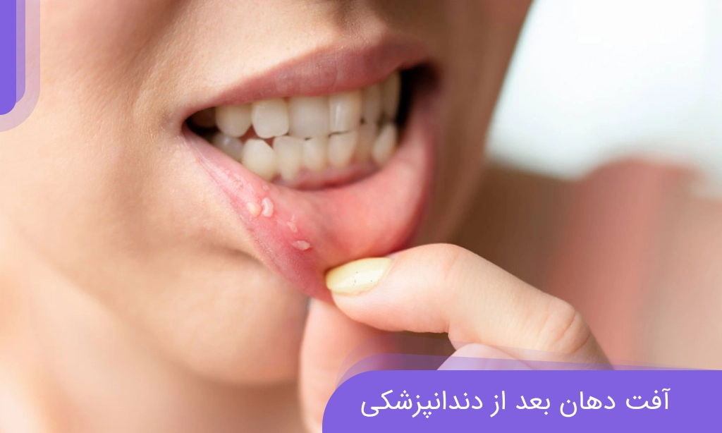 آفت دهان بعد از دندانپزشکی