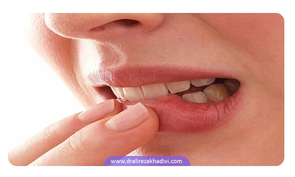 پرهیز از جویدن گوشه لب برای ایجاد آفت درون دهان بعد از دندانپزشکی