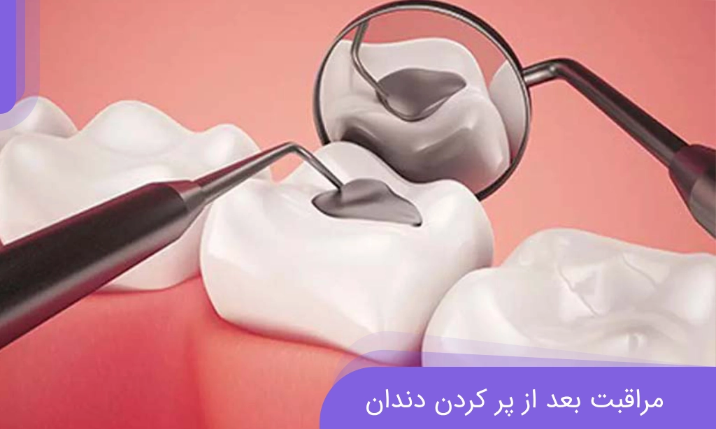 مراقبت بعد از پر کردن دندان