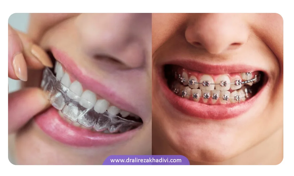 ارتودنسی ژله ای بهتر است یا فلزی