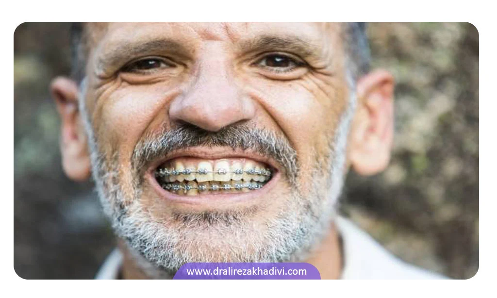 درمان ارتودنسی ثابت دو فک برای افراد مسن