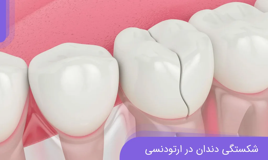 شکستگی دندان در ارتودنسی