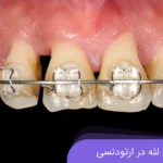 تحلیل لثه در ارتودنسی